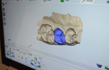 3D Tooth imaging