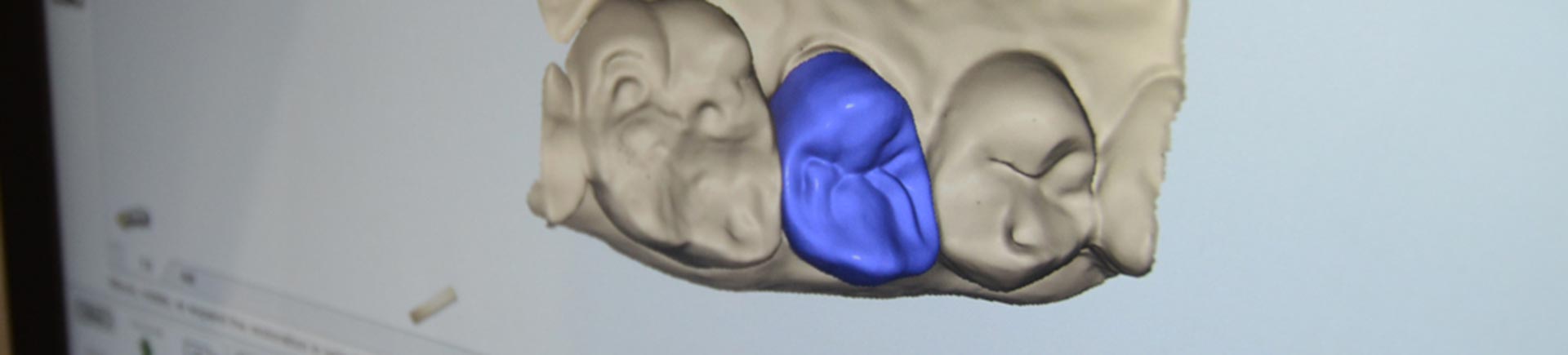 3D Tooth imaging
